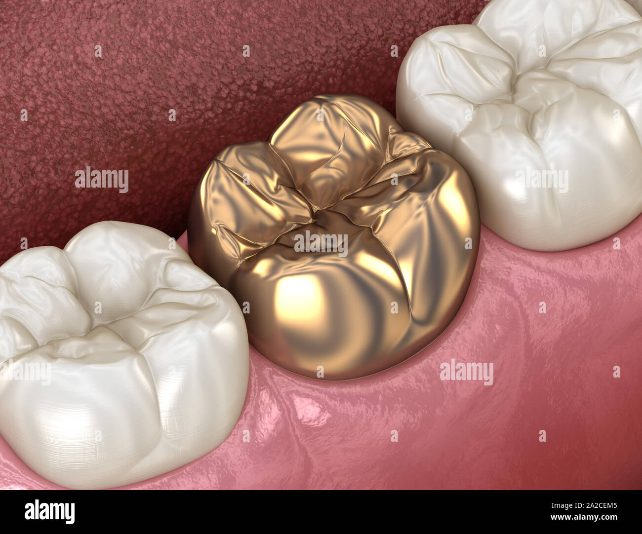 Golden crown molar tooth assembly process. Medically accurate 3D
