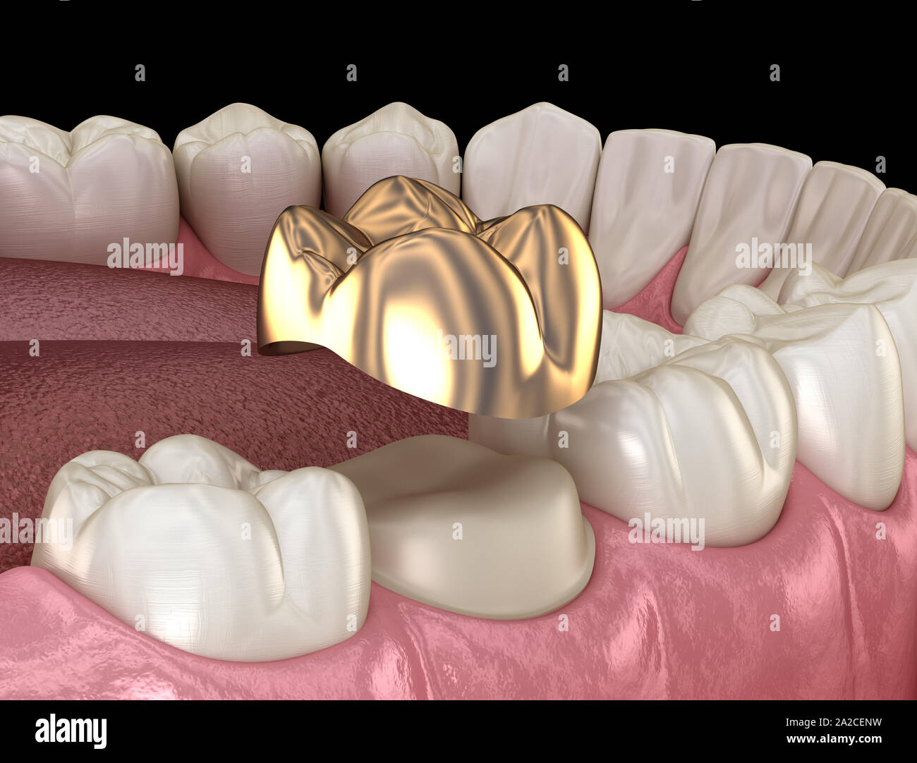 Golden crown molar tooth assembly process. Medically accurate 3D