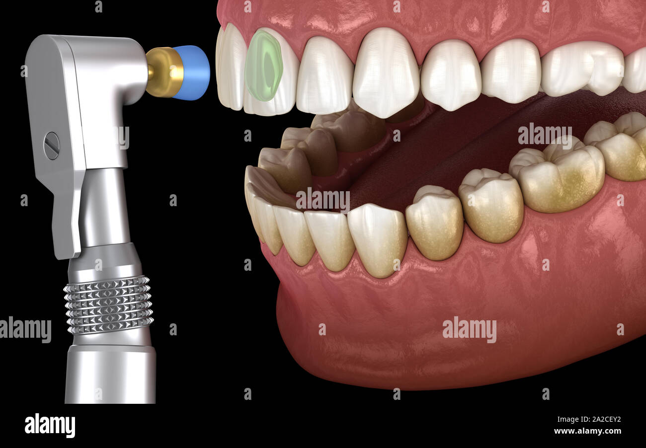Polish tooth restoration hires stock photography and images Alamy