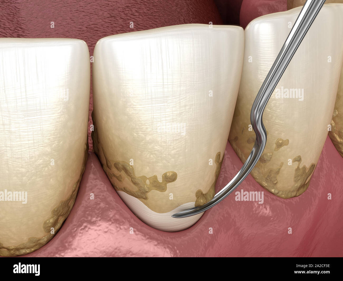 Oral hygiene Scaling and root planing (conventional periodontal