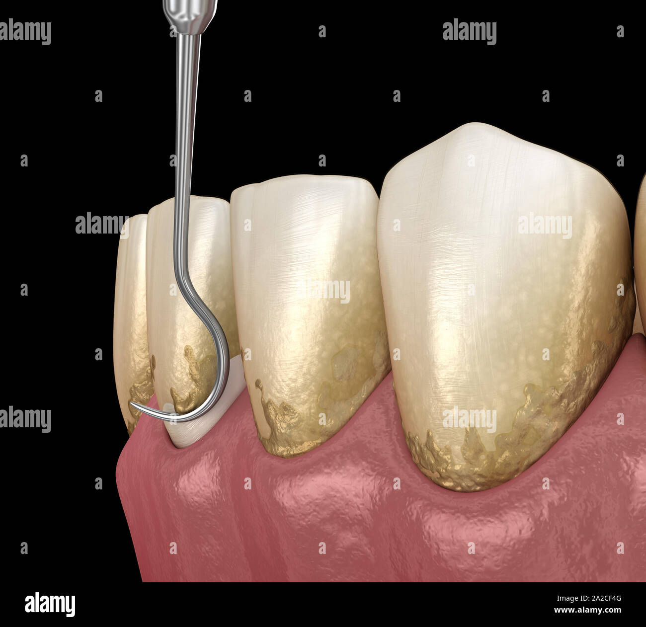 Oral hygiene Scaling and root planing (conventional periodontal