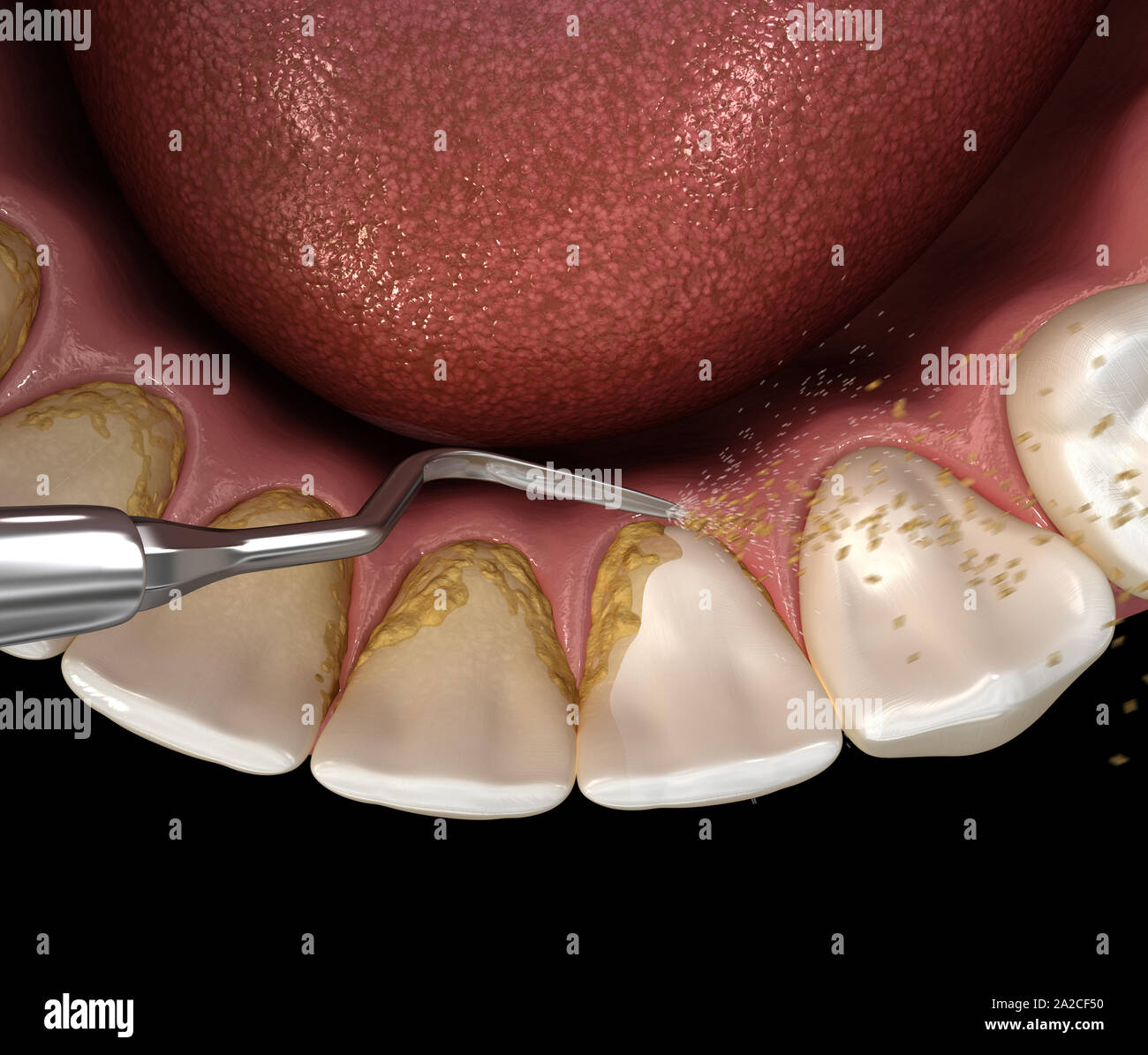 Oral hygiene Ultrasonic teeth cleaning machine removing calculus and