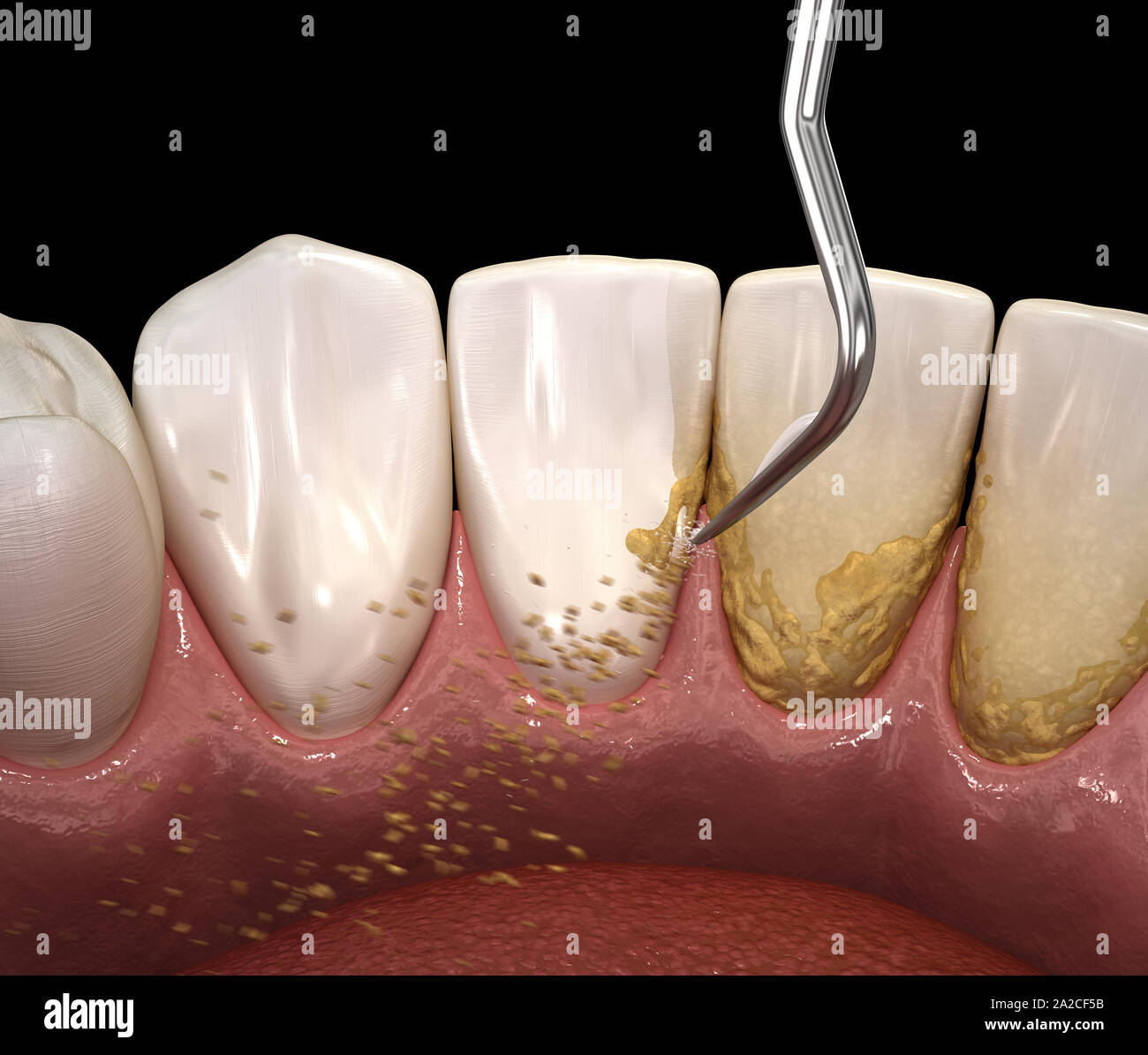 Oral hygiene Ultrasonic teeth cleaning machine removing calculus and
