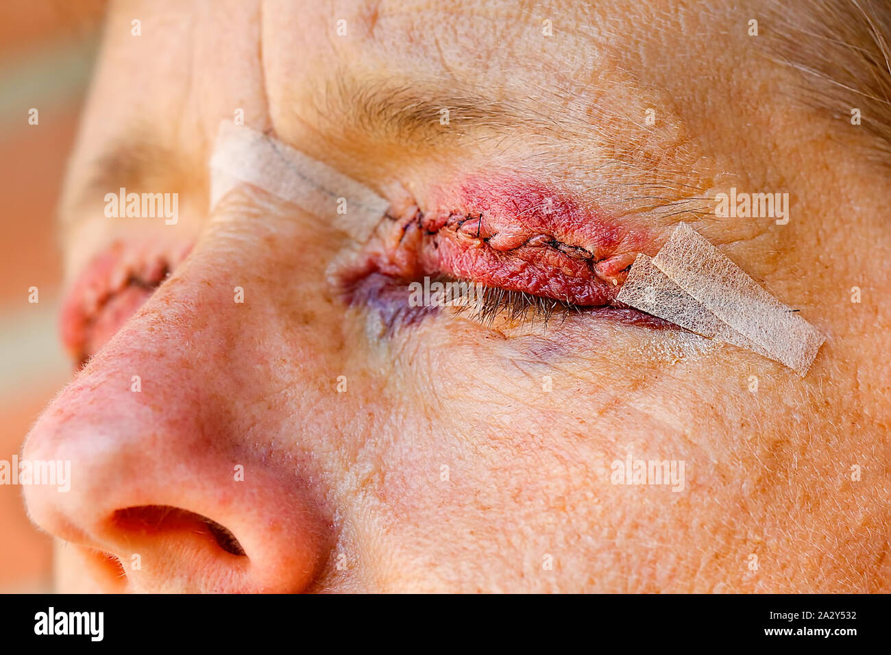 Close up eyelid correction closed eye and nose Stock Photo