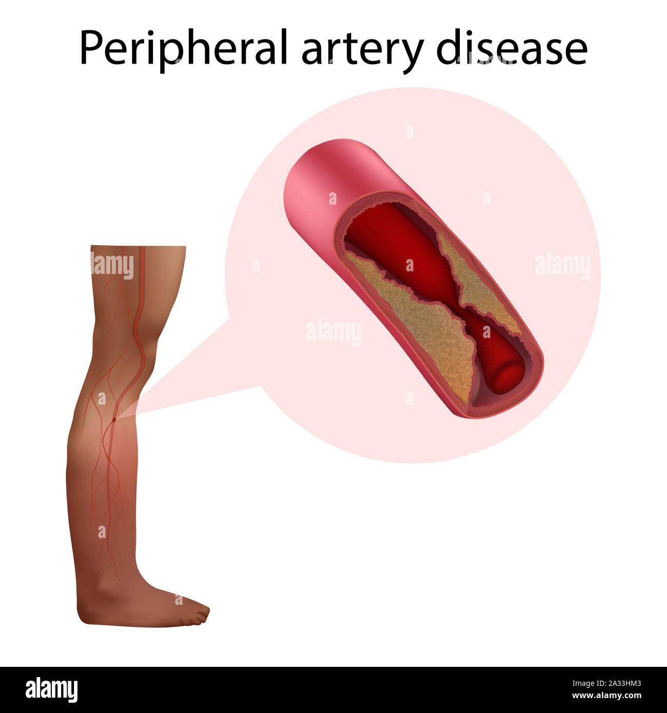 Peripheral artery disease, illustration Stock Photo - Alamy