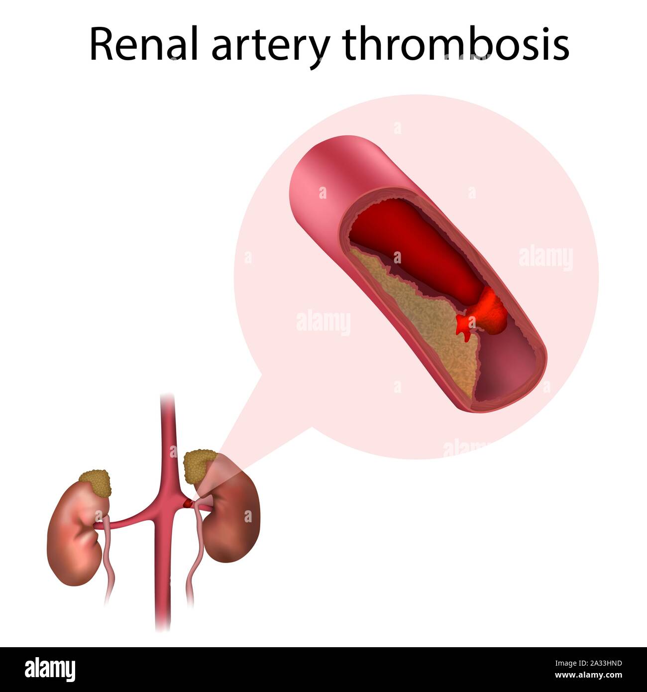 Renal artery thrombosis, illustration Stock Photo Alamy
