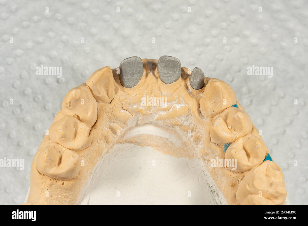 metal cast pin of a human tooth on a gypsum model close-up in dental ...