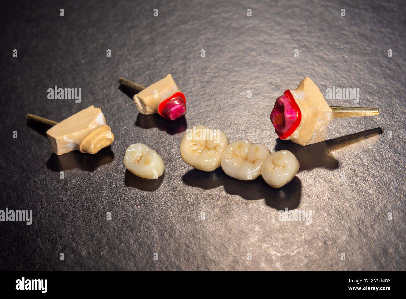 Ceramic tooth crowns and metal pins close-up macro. Orthopedic dentistry restoration decayed teeth Stock Photo