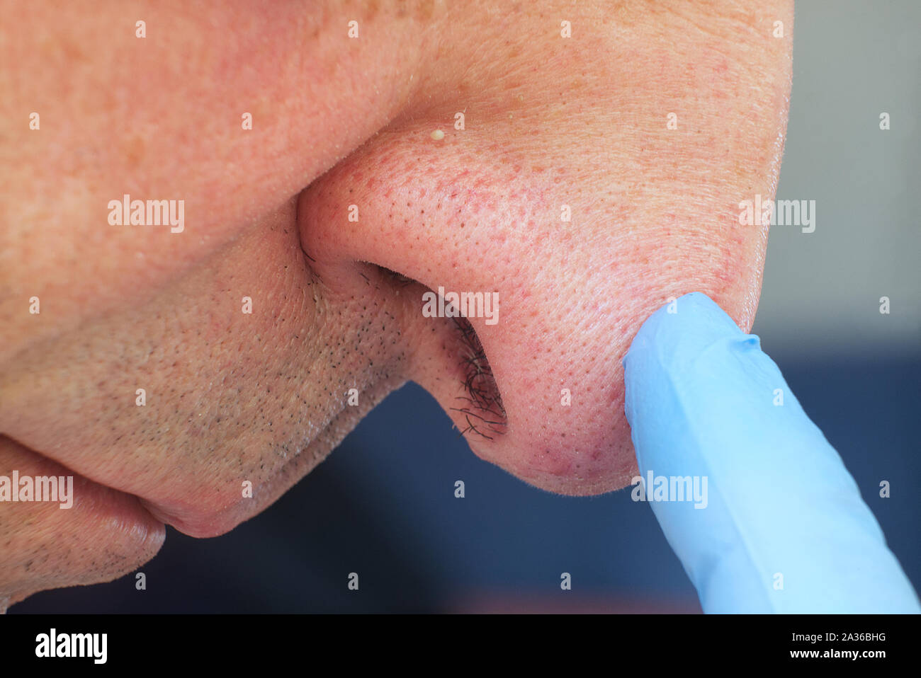 Close up man face with whitehead pimples on nose, acne disease. Stock Photo