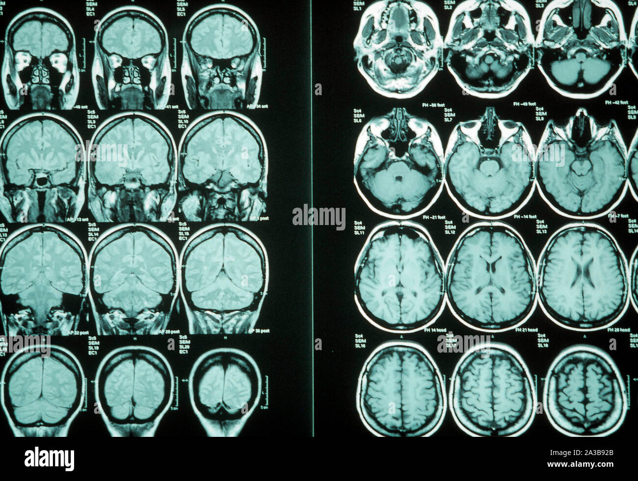magnetic resonance, MRI scan, brain Stock Photo