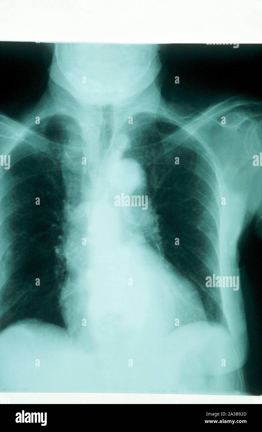 x-rays, pulmonary emphysema Stock Photo - Alamy