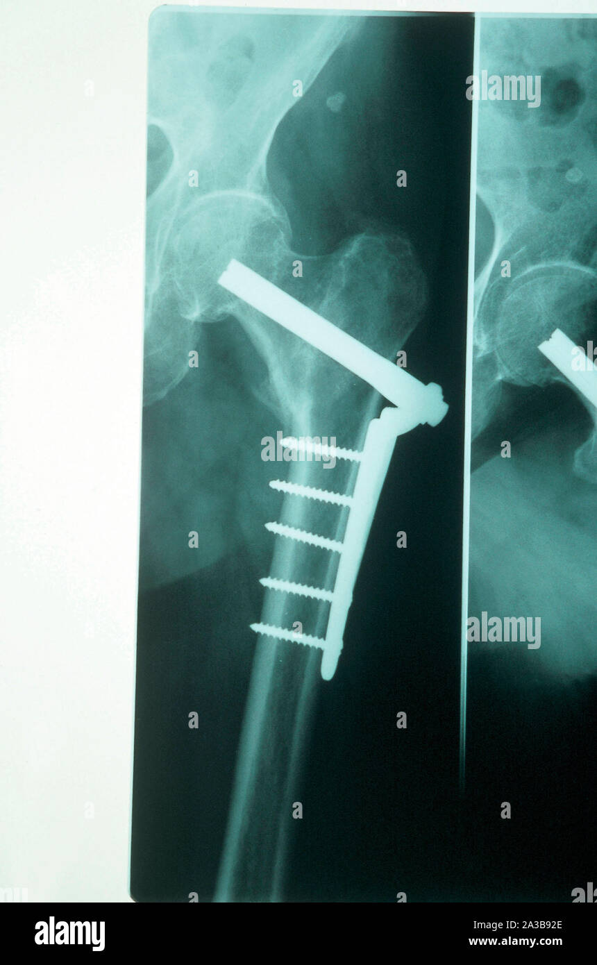x-rays, prosthesis, hip Stock Photo