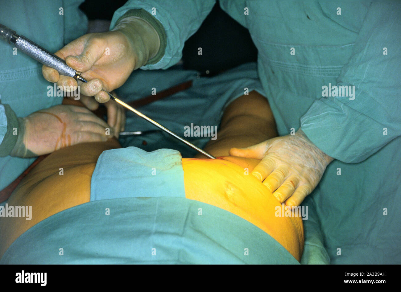 medicine, cosmetic surgery, liposuction Stock Photo