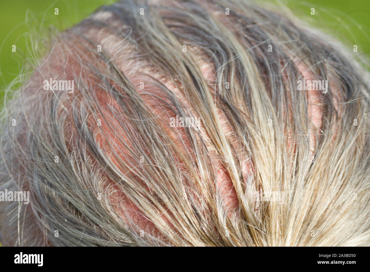 Human alopecia or hair loss. Man starting to get bald Stock Photo