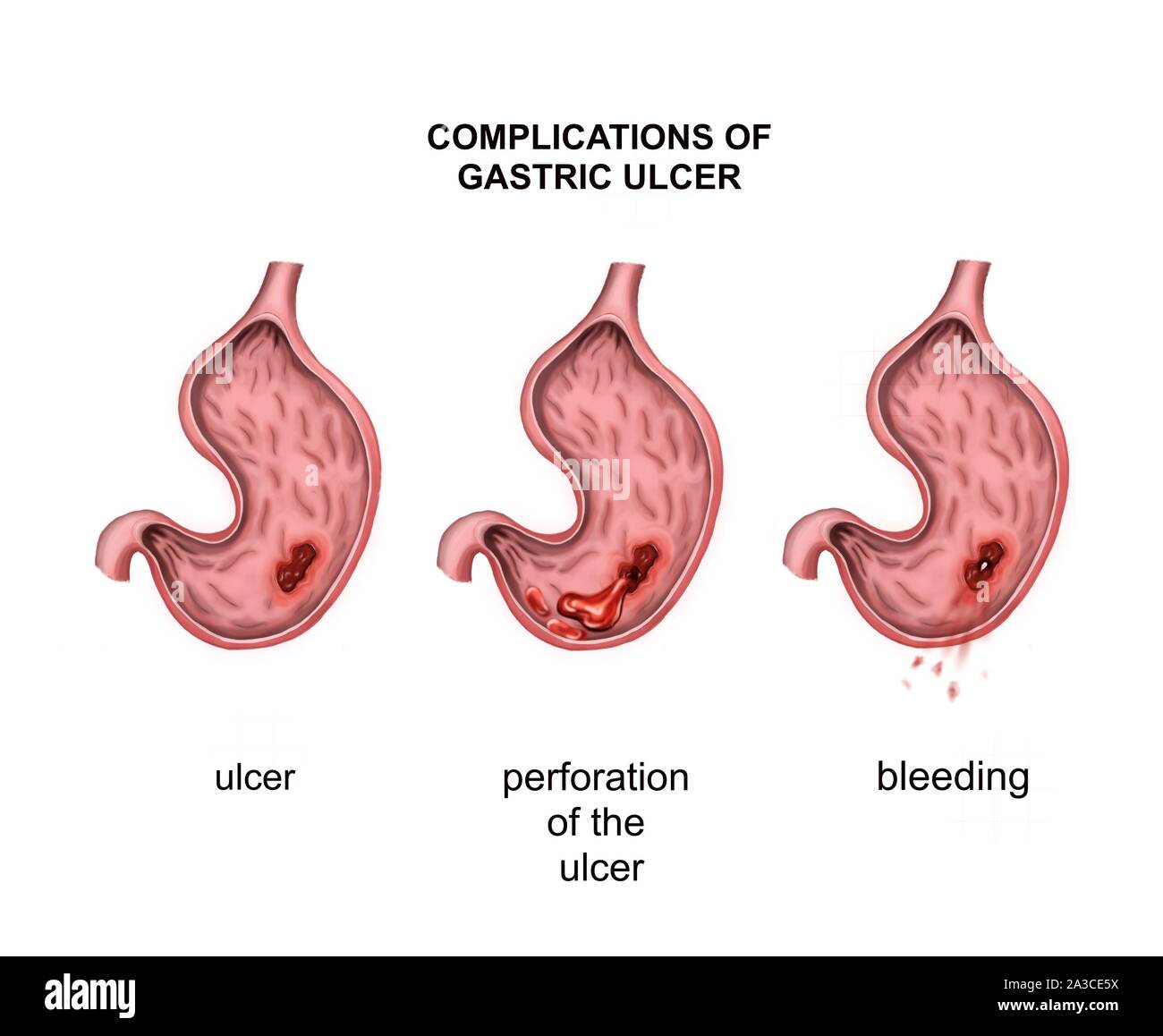 Oncology. Ulcer. Complications: perforation and bleeding Stock Photo