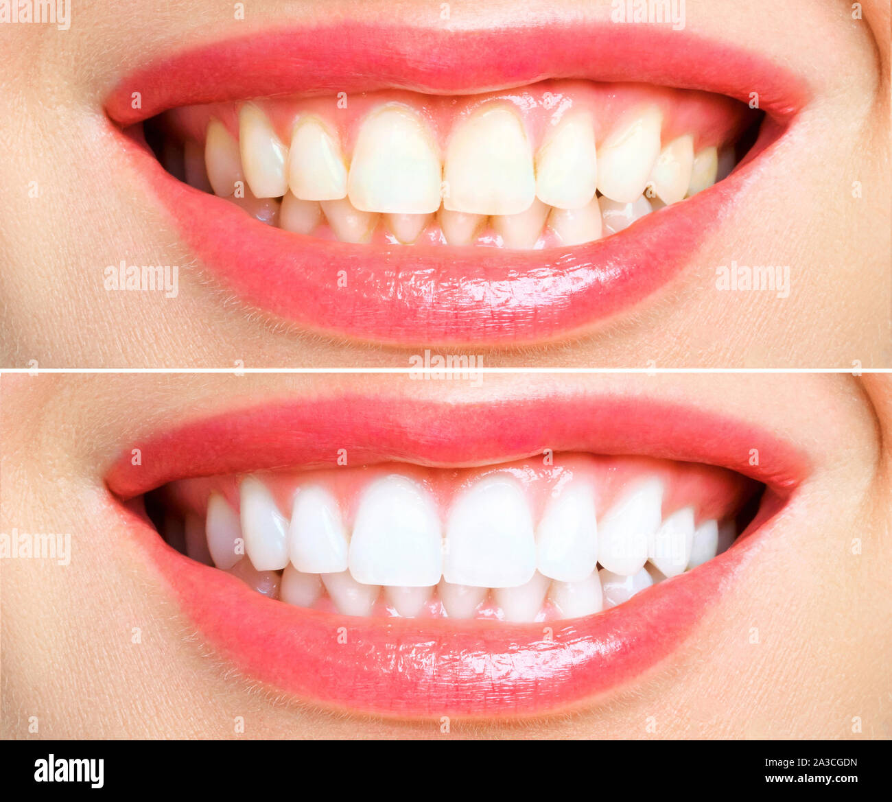 woman teeth before and after whitening. Over white background Stock Photo