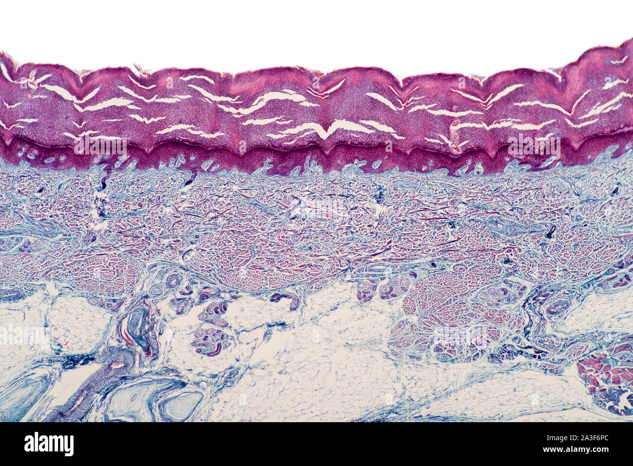 Plantar fasciitis skin, human, VS, sweat glands Stock Photo