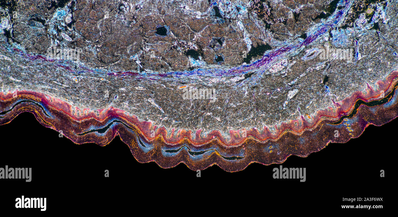 Plantar fasciitis skin, human, VS, sweat glands Stock Photo