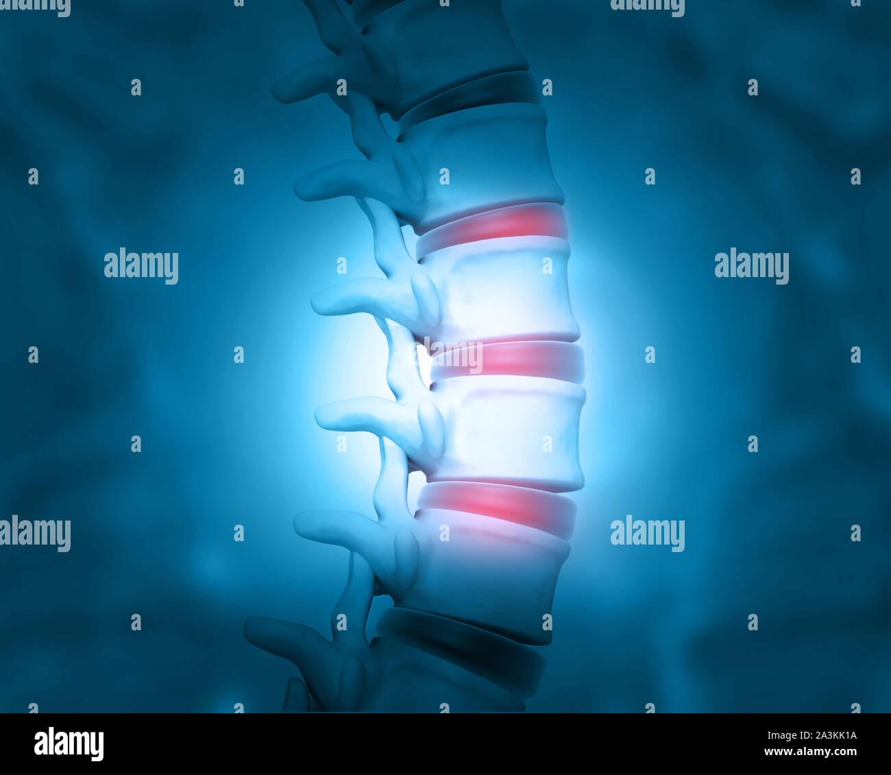 Disc problem of human spine. 3d illustration Stock Photo