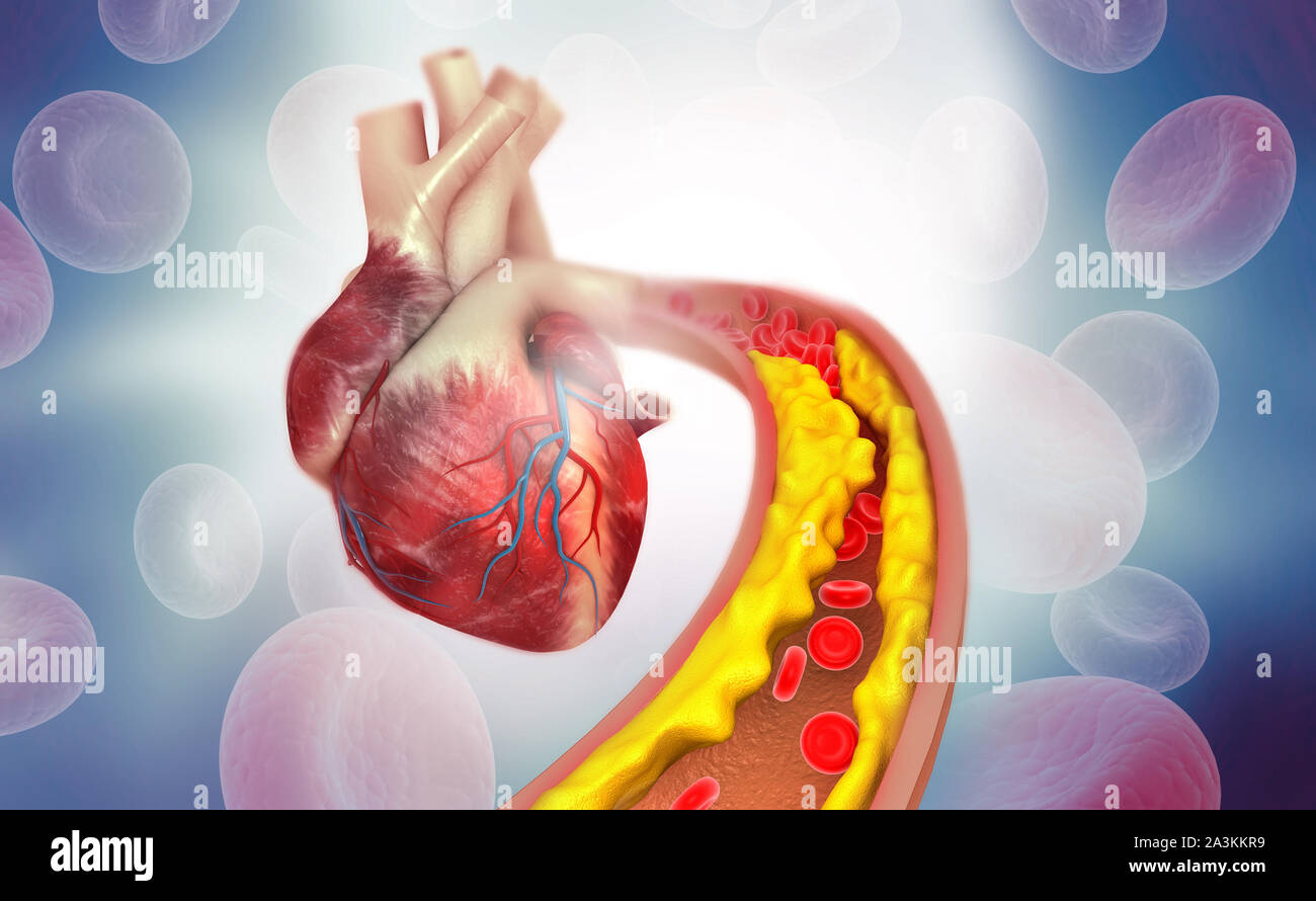 Cholesterol plaque in artery with Human heart anatomy. 3d illustration