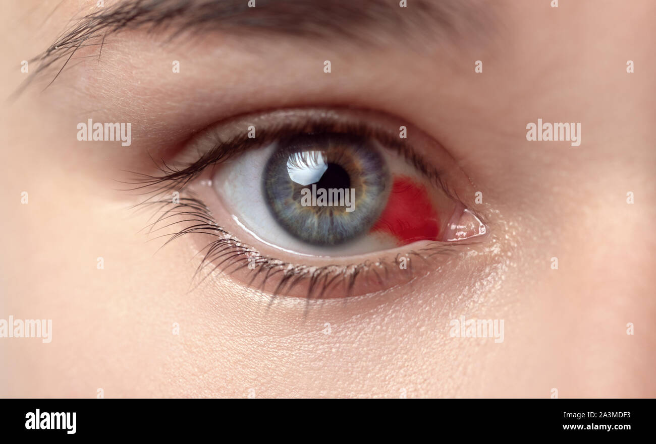 Bloodshot Eye Woman With Burst Blood Vessel In Eye Very Red Bloody 