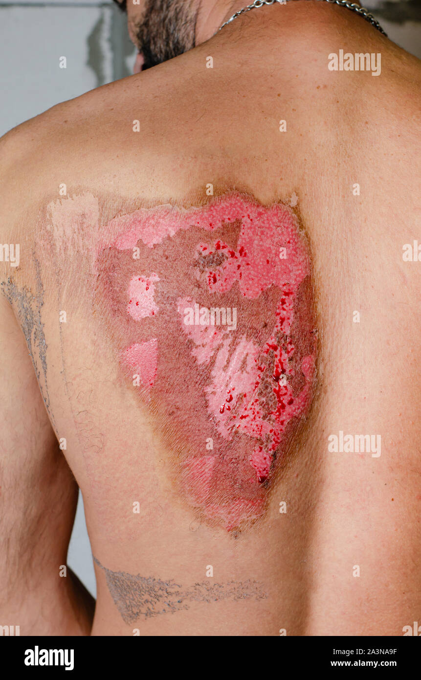 cigarette burns on back Child abuse: wound caused by cigarette burn - Stock Image - M330/0108