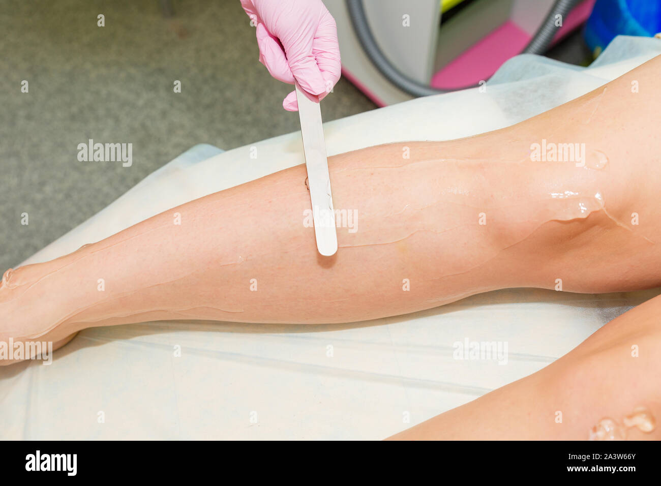 cosmetic laser hair removal
