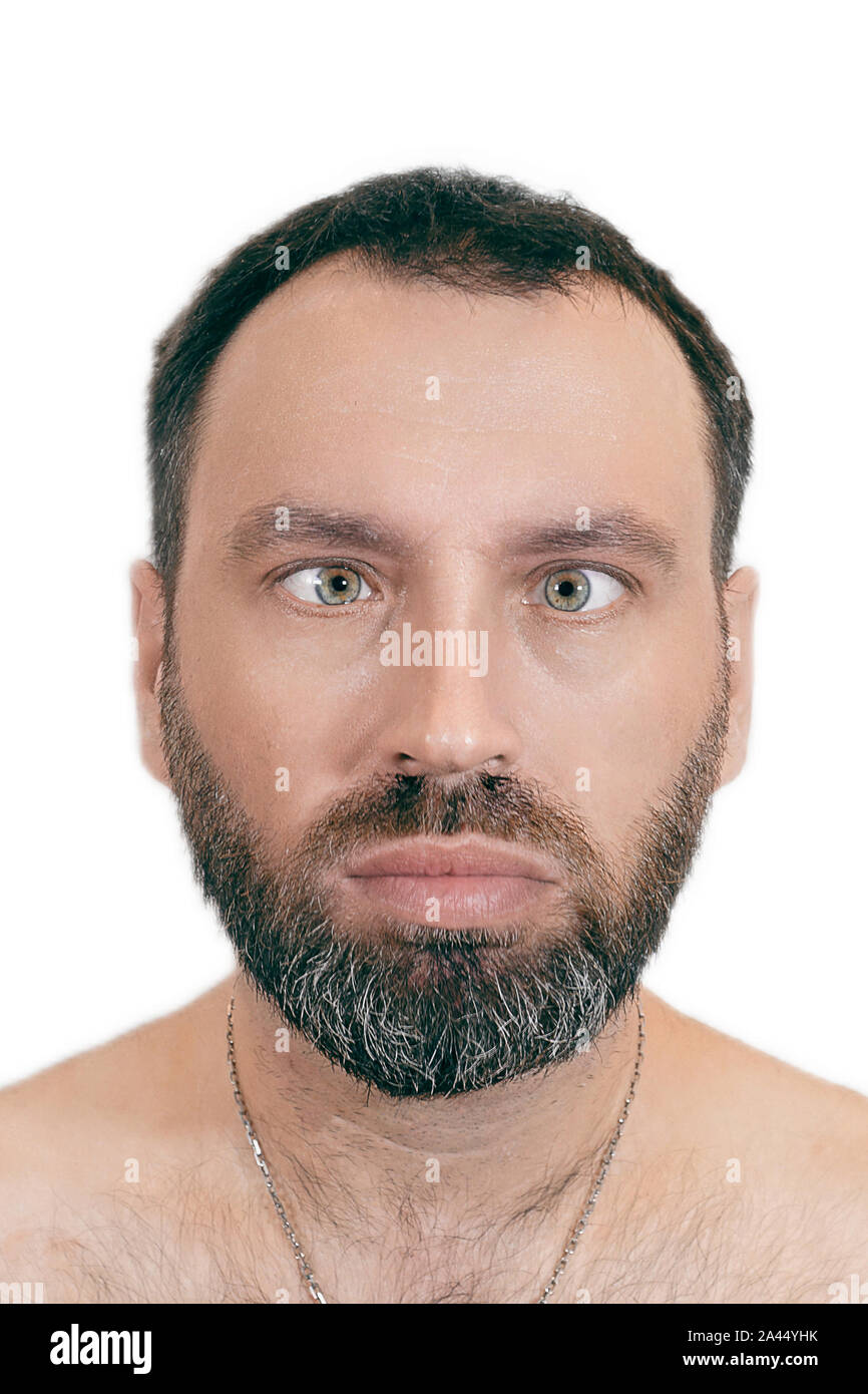 A man with strabismus. Orthoptics. ophthalmology concept. Medical desease. Stock Photo