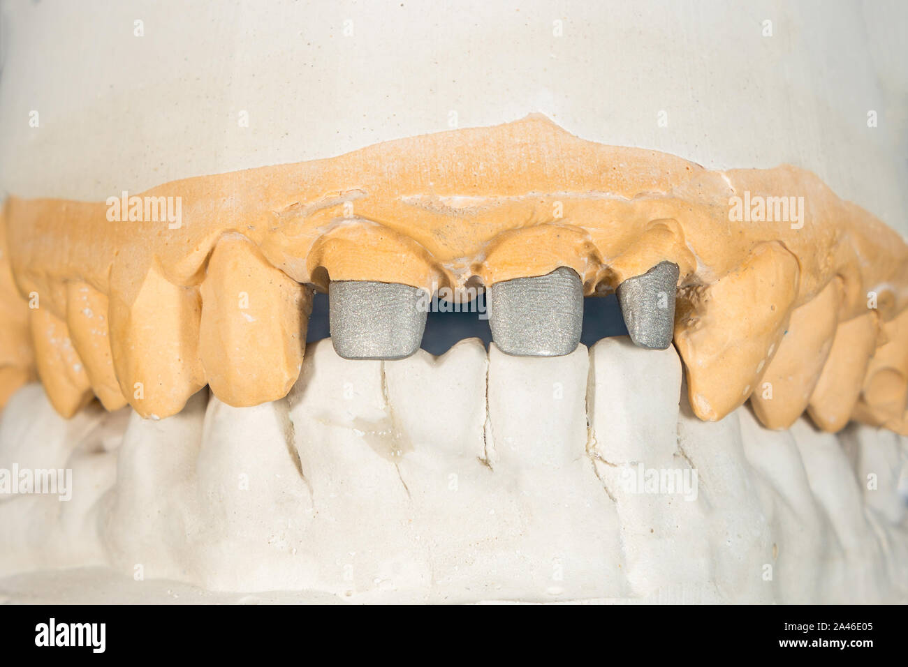 metal cast pin of a human tooth on a gypsum model closeup in dental