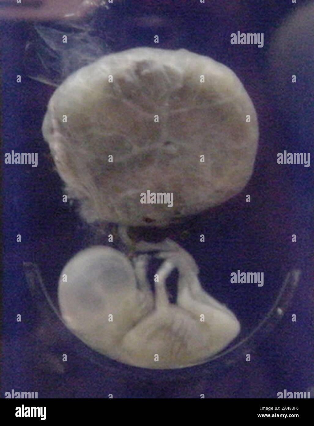 3 months fetus hi res stock photography and images alamy