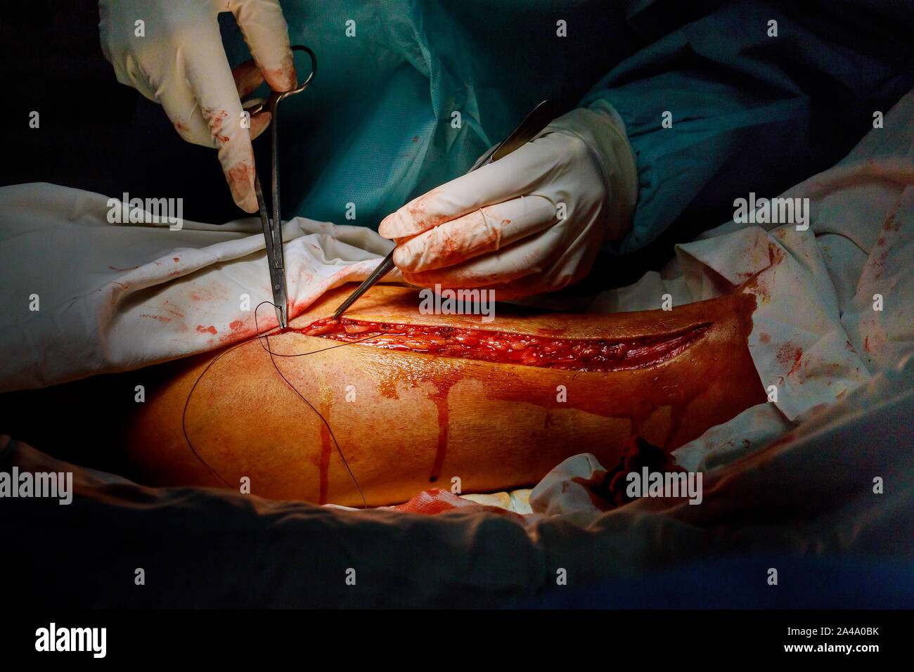 Operation of varicose veins leg surgery by surgeon in operating room  operation medical procedure Stock Photo - Alamy