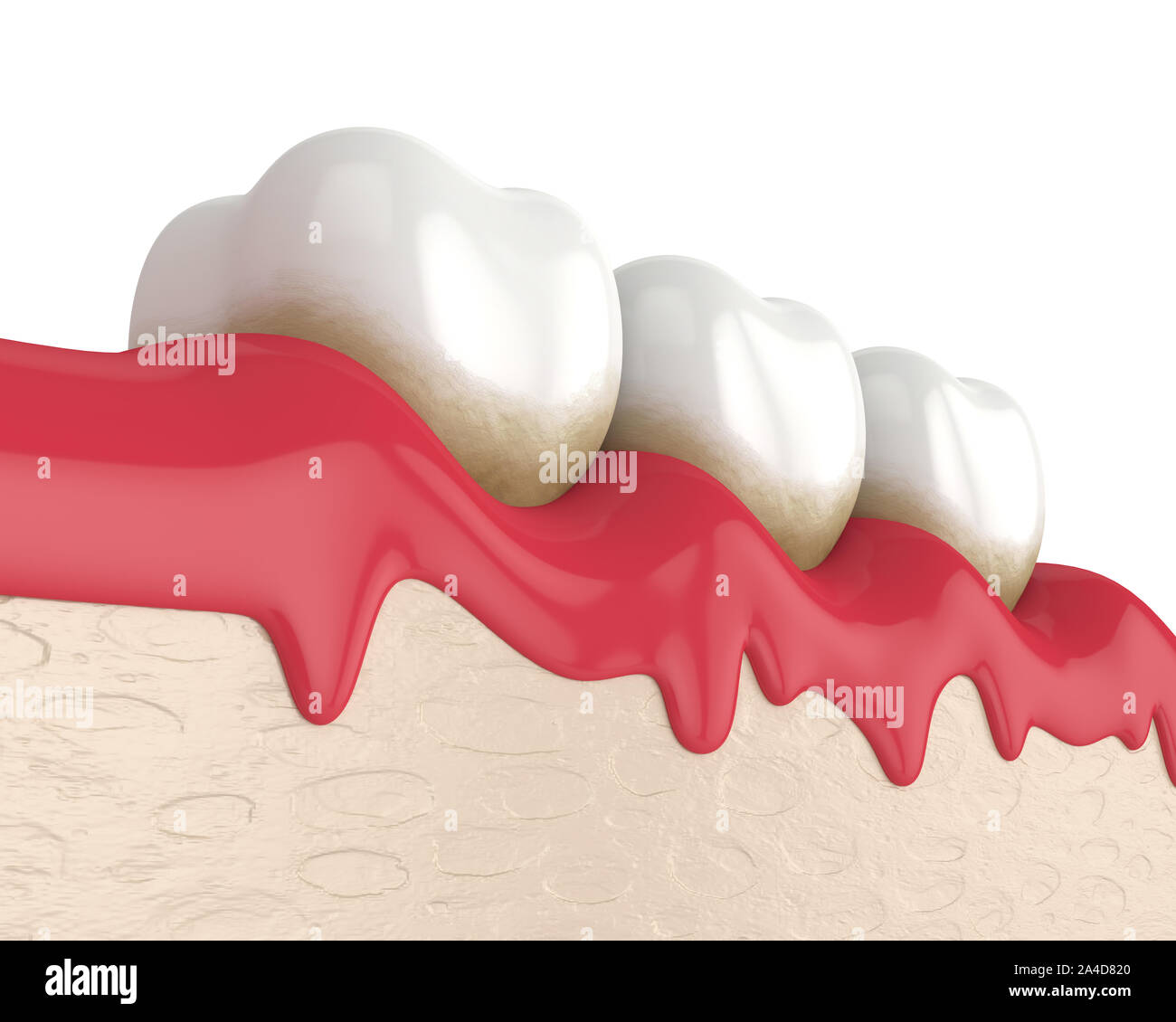 3d render of teeth in bleeding gums over white background. Periodontal