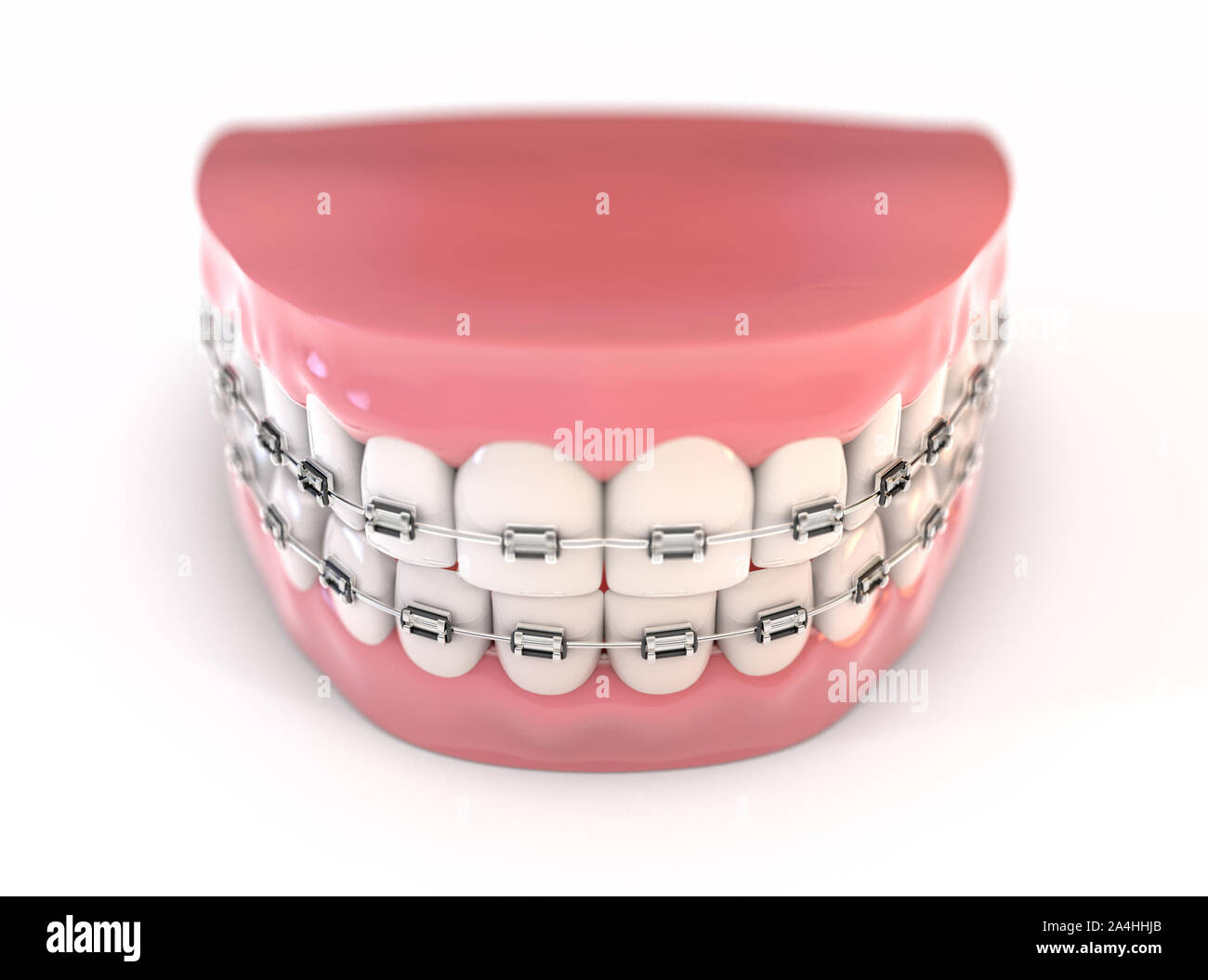 A pair of upper and lower sets of perfect human teeth fitted with steel