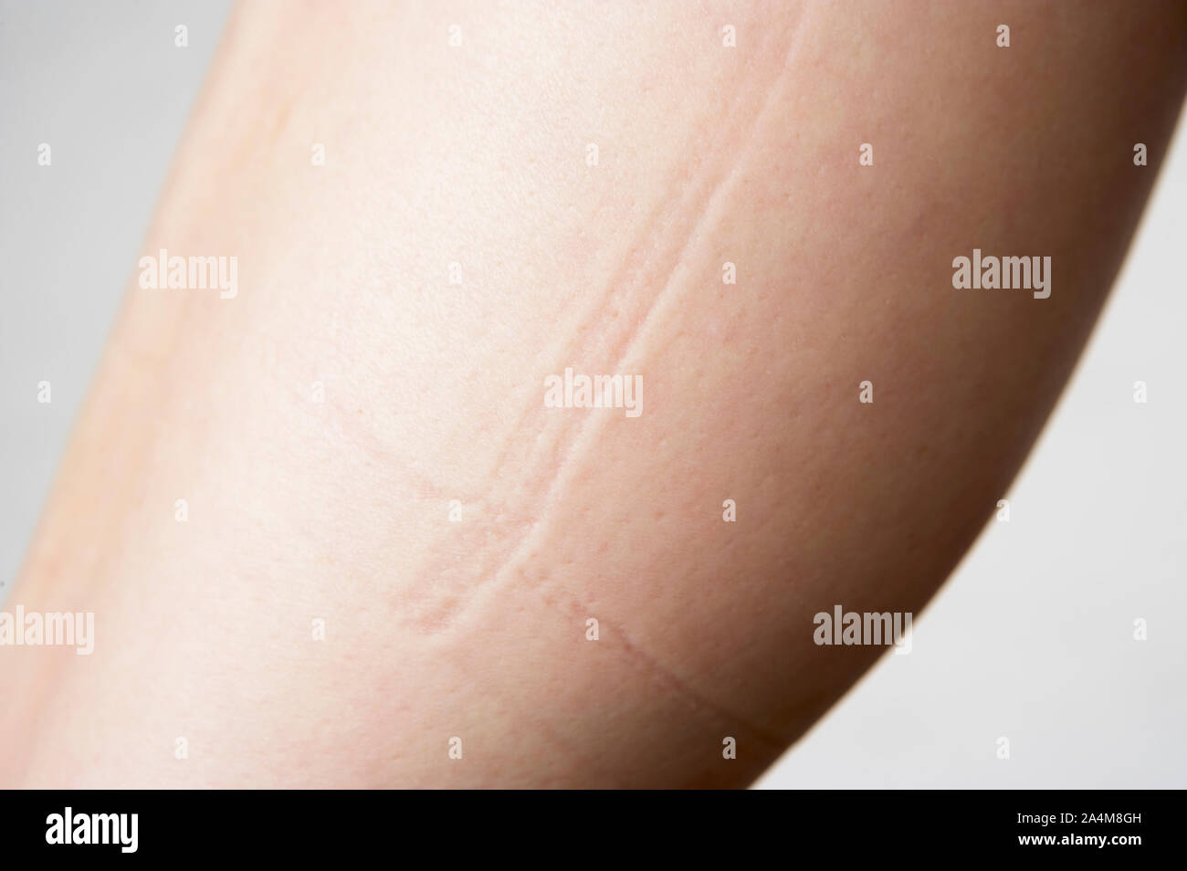 Woman's leg with marks from tight clothing Stock Photo