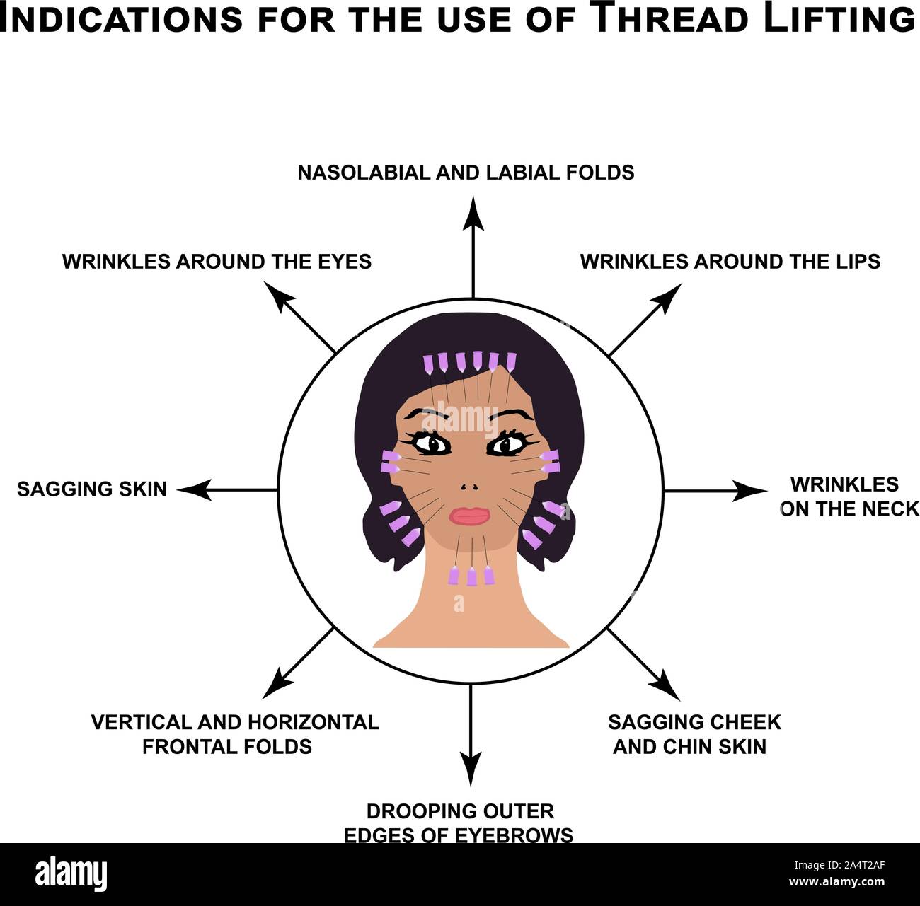 Indications for the use of thread lifting. Mesotherapy Wrinkles. Infographics. Vector illustration on isolated background. Stock Vector