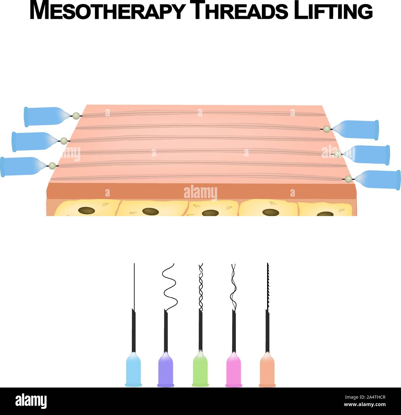 Mesotherapy Threads Lifting. Different types of threads for facelift. The structure of the skin. Wrinkles. Infographics. Vector illustration on Stock Vector