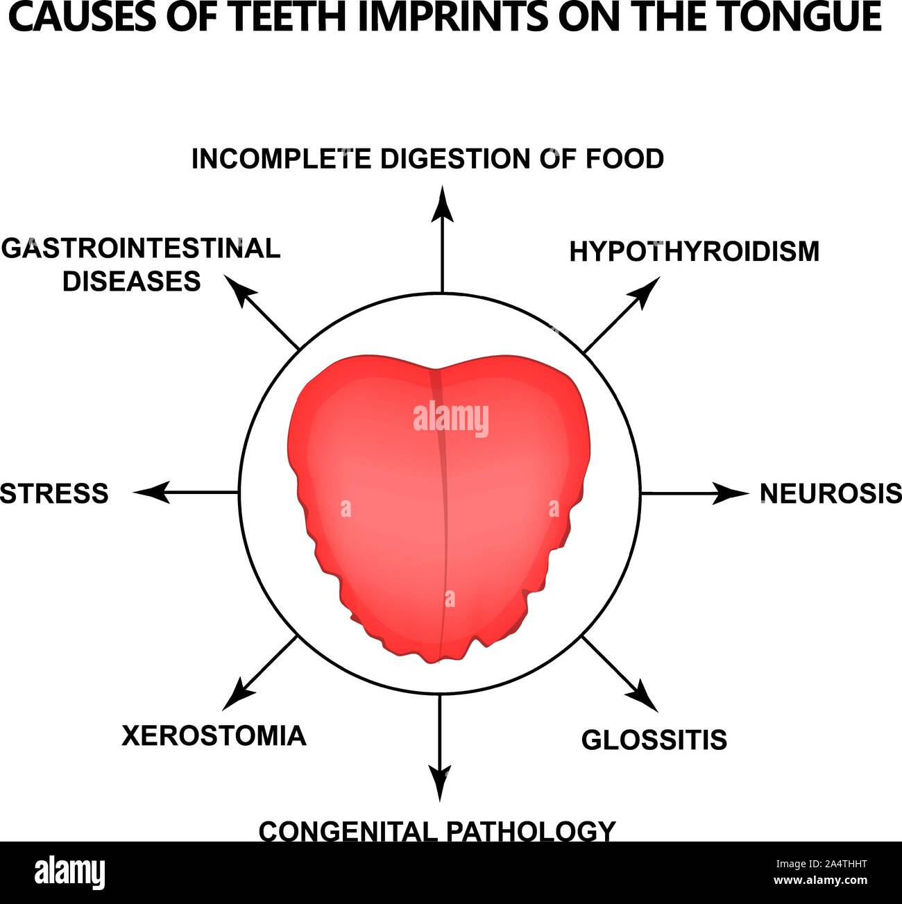 Causes of Teeth Imprints on the Tongue. Definition of a disease