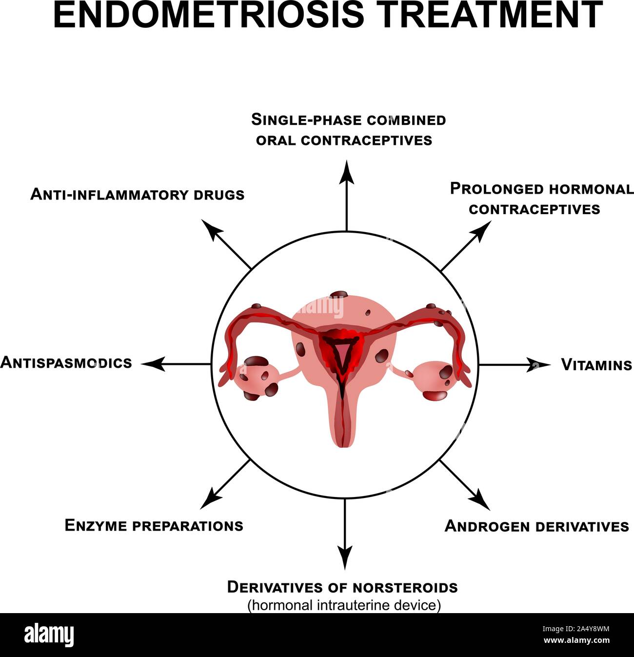 Treatment of endometriosis. Adenomyosis. The structure of the pelvic