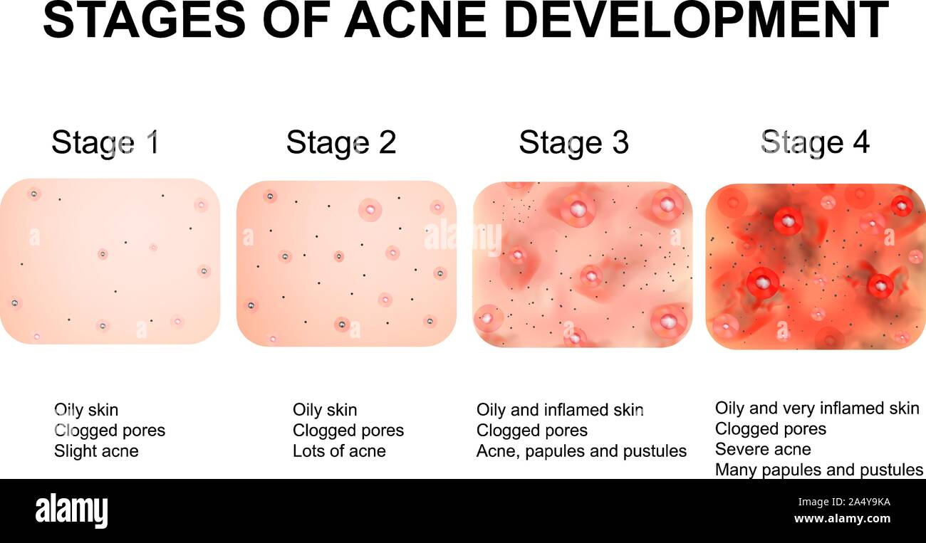 Stages Of Development Of Acne Inflamed Skin With Scars Acne And