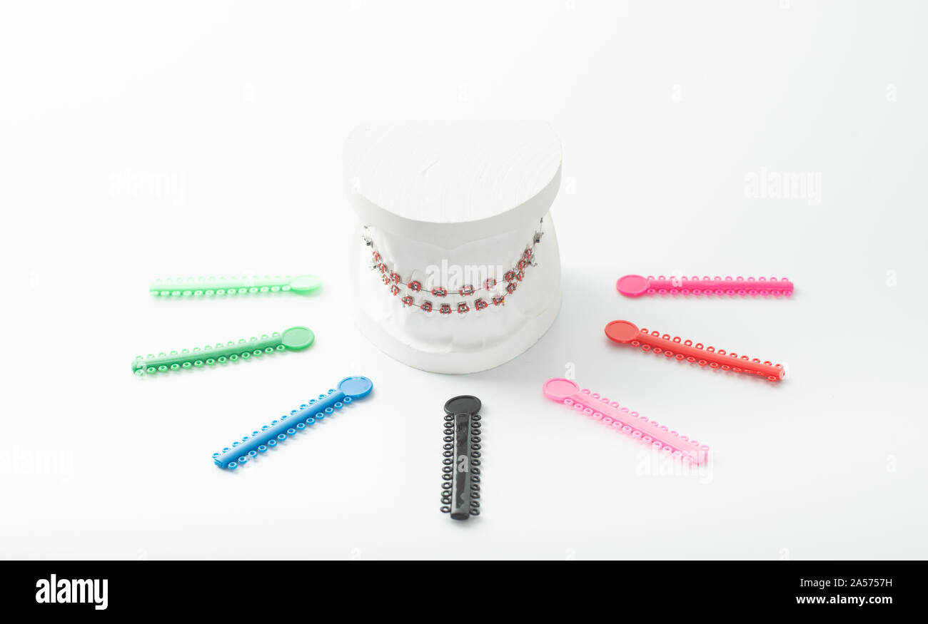 Example of orthodontic model made from white cement with braces and