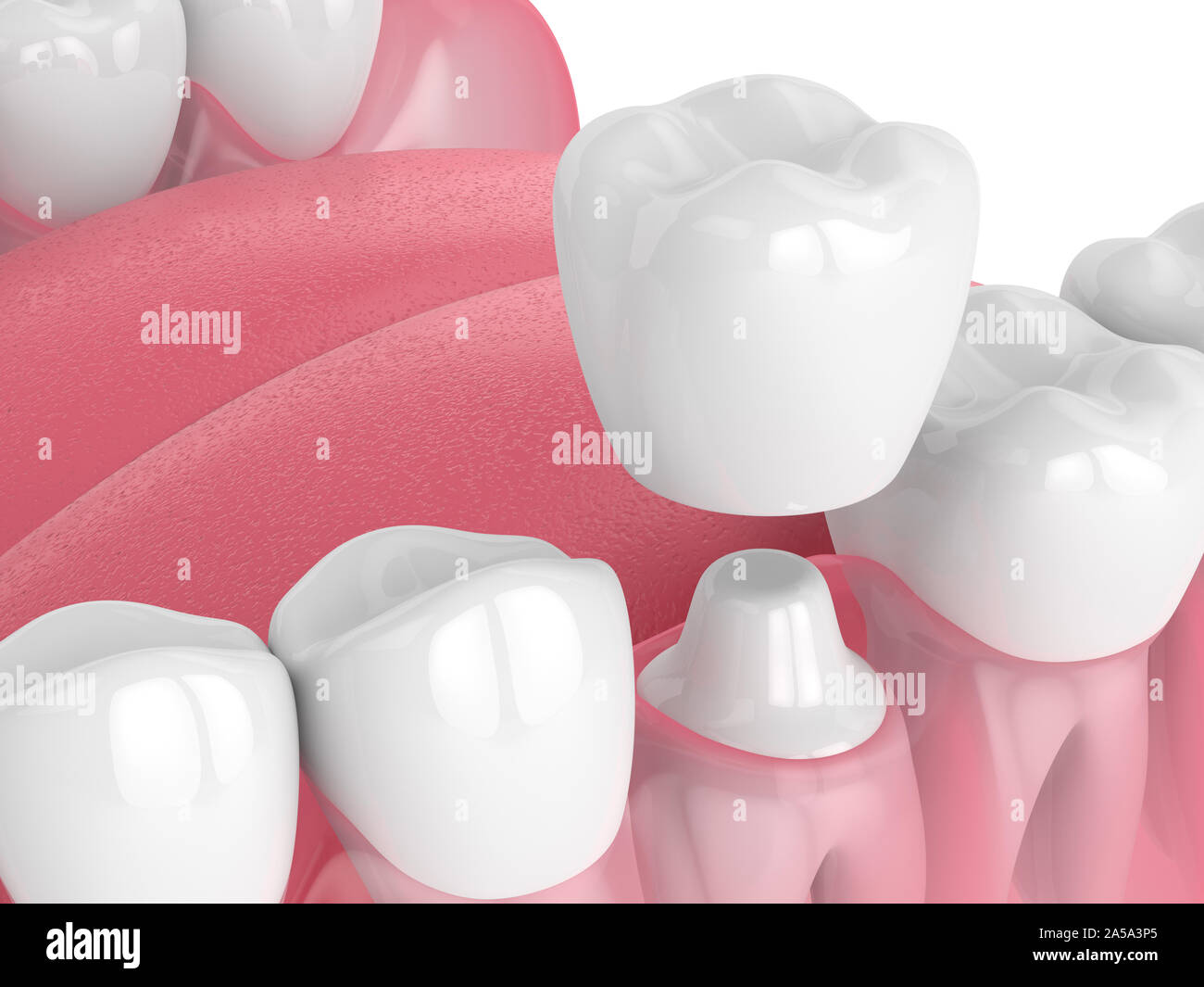 3d render of jaw with teeth and dental crown restoration over white ...