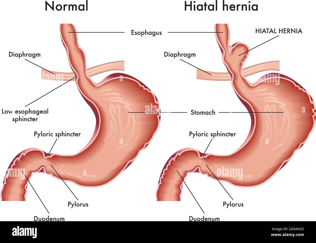Medical illustration of stomach with hiatal hernia with annotation. Stock Vector