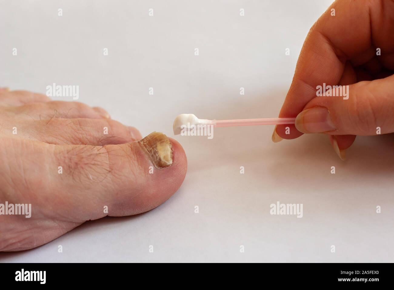 The female hand applies a cotton swab cream to the toenail affected by