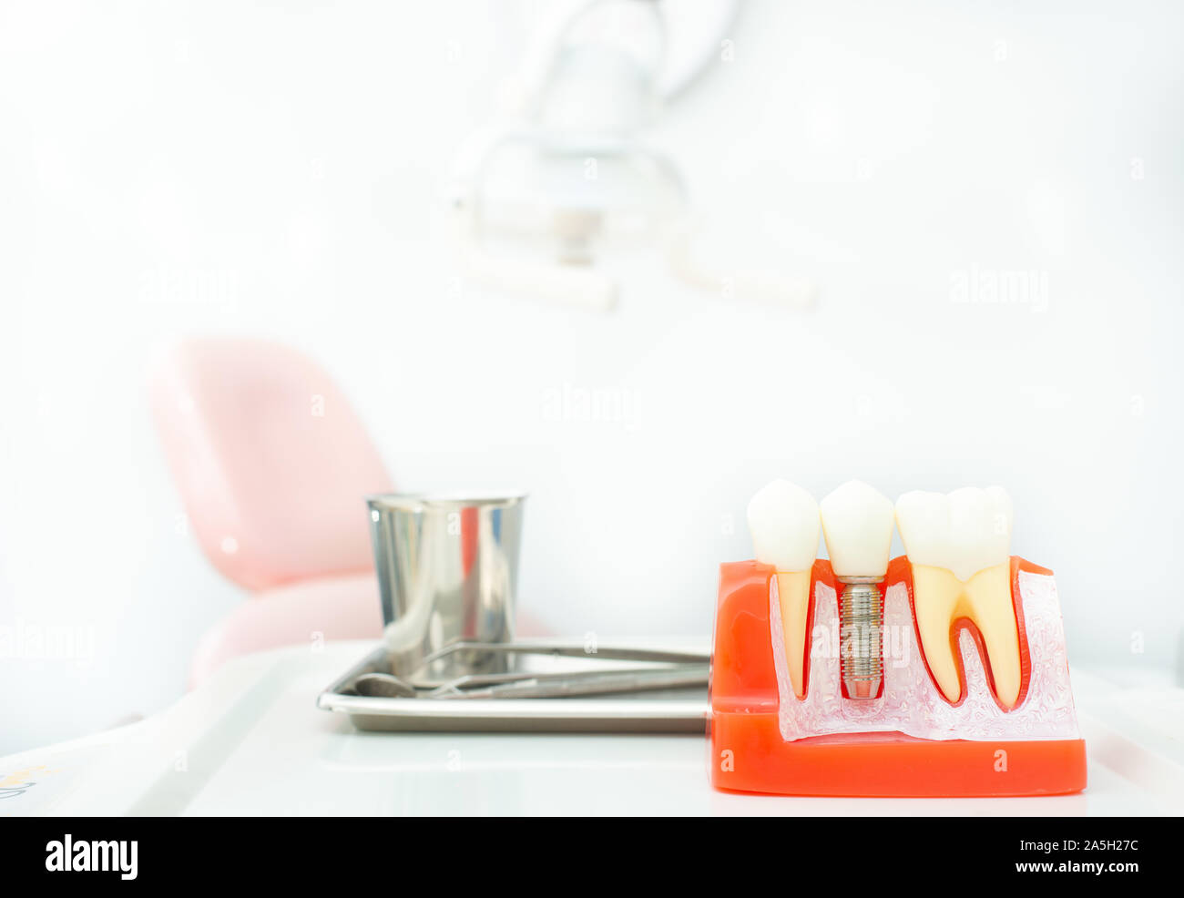 Plastic dental implant model for education patient Stock Photo Alamy