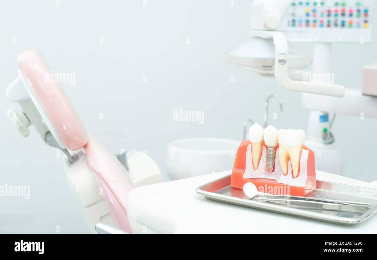 Plastic dental implant model for education patient Stock Photo Alamy