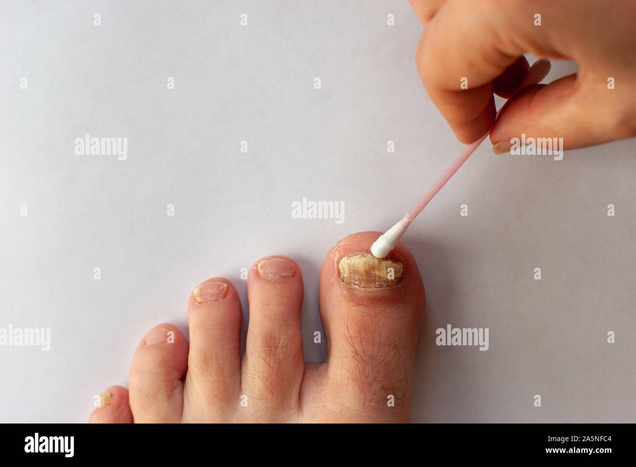 Toenail care with fungus. Toenail plate is affected by fungus. Female hand with a cotton swab