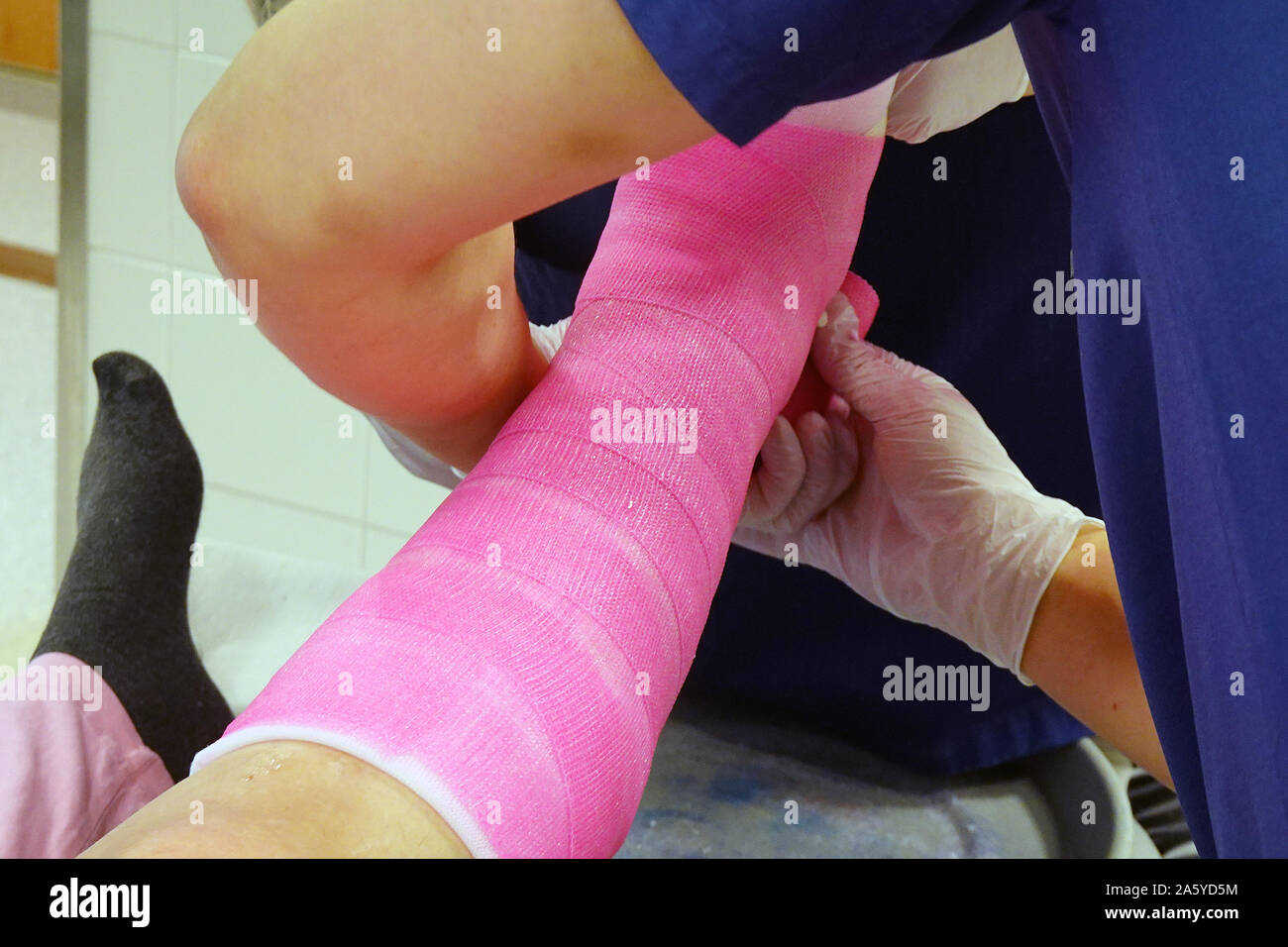 Orthopedic cast. Doctor plastering fractured ankle of patient using pink fibreglass top layer. Stock Photo