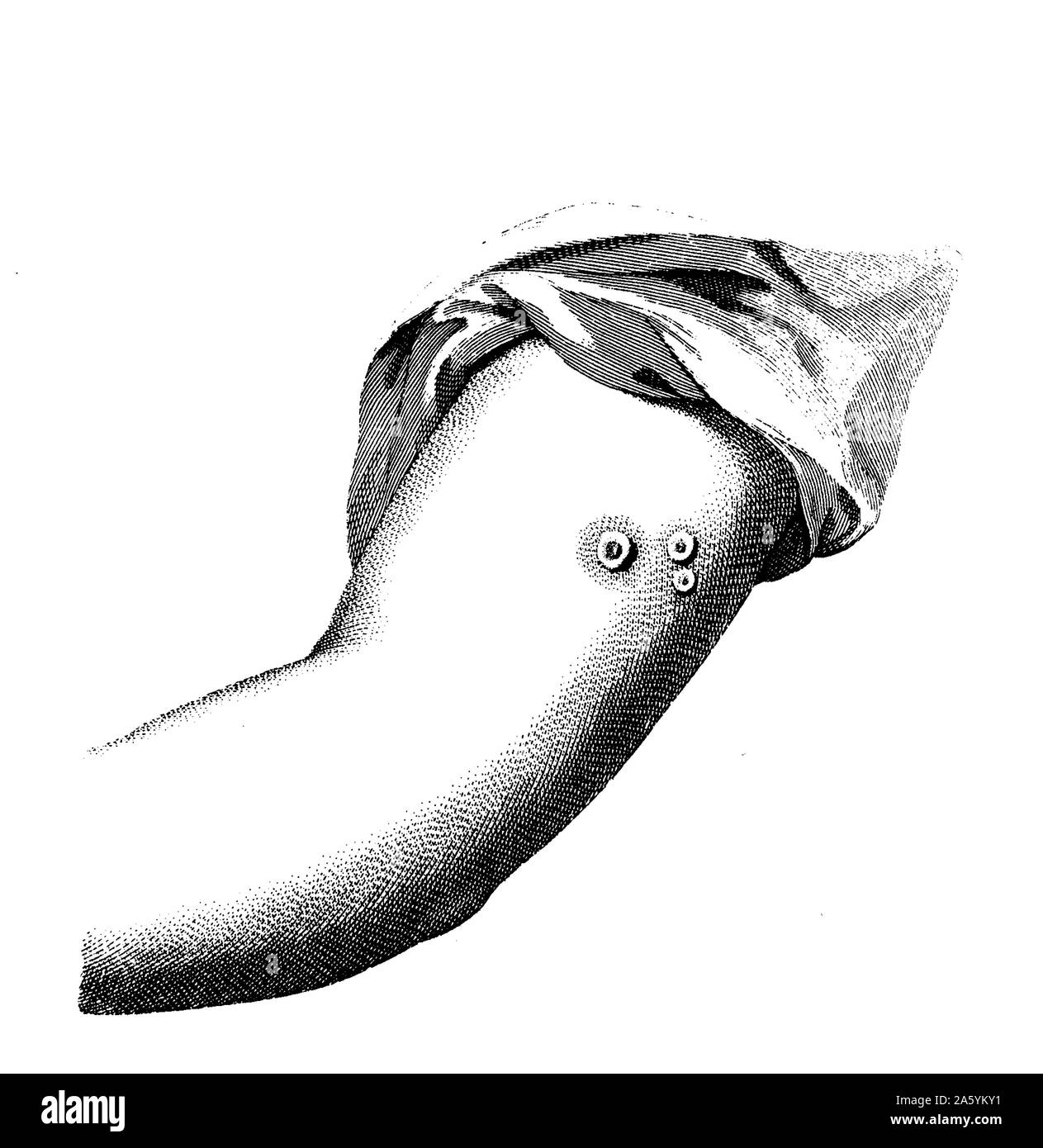 Cowpox pustules Cut Out Stock Images & Pictures Alamy