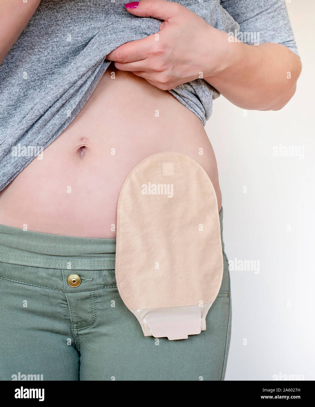 Front view on colostomy bag in skin color attached to young woman patient. Close-up on ostomy bag. Colostomy pouch. Colon cancer surgical treatment. Stock Photo