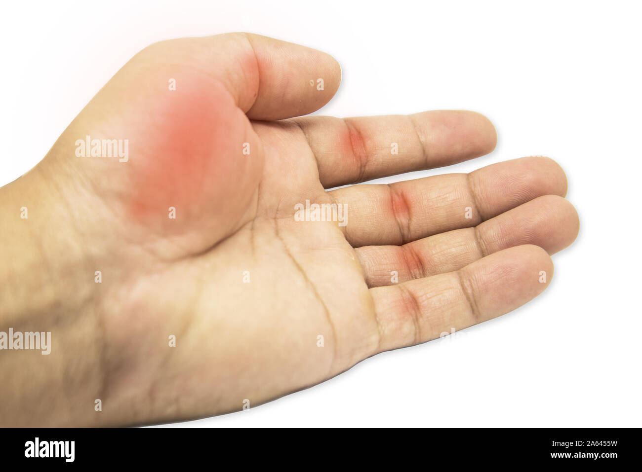 Rheumatoid Arthritis, Trigger finger, arthritis, wrist pain isolated on